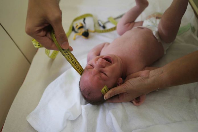 Bebê com microcefalia no Brasil FOTO: Getty Images