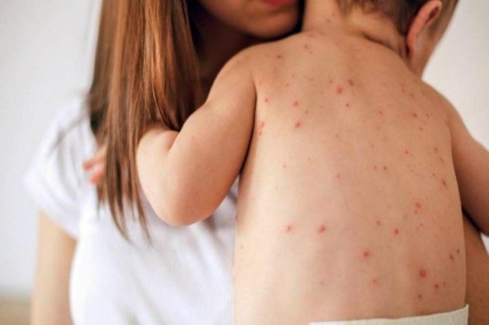De acordo com o órgão, desde o início de março deste ano, já houve 2.231 notificações de suspeita de infecção pelo vírus Morbilivirus De acordo com o órgão, desde o início de março deste ano, já houve 2.231 notificações de suspeita de infecção pelo vírus Morbilivirus