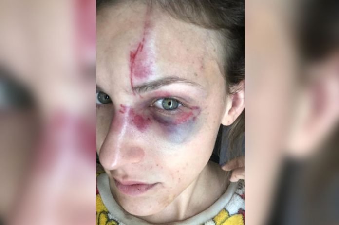 Melissa Gentz depois de ser espancada — Foto Arquivo pessoal