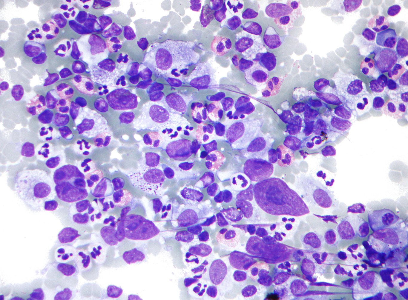 O linfoma não Hodgkins é um tipo de tumor de alto risco (Foto: Nephron)