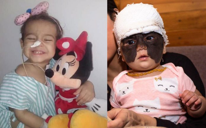 Bella, de 4 anos, foi diagnosticada com um tipo raro de leucemia e sonha em ser bailarina; Na Rússia, após as primeiras cirurgias para a retirada no nevo, Luna mostra que é uma guerreira