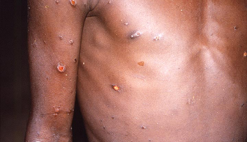 Esses são alguns dos sistemas da varíola de macacos no corpo humano (Foto: my.clevelandclinic.org)