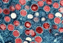 Legenda: Monkeypox é uma doença semelhante à varíola, embora mais suave e menos fatal (Foto: cbs12.com)