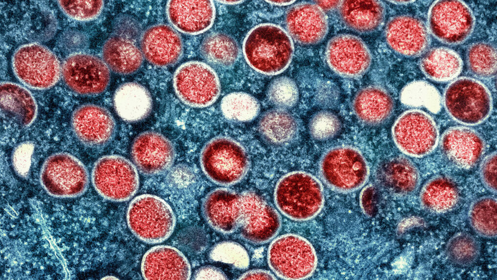 Legenda: Monkeypox é uma doença semelhante à varíola, embora mais suave e menos fatal (Foto: cbs12.com)