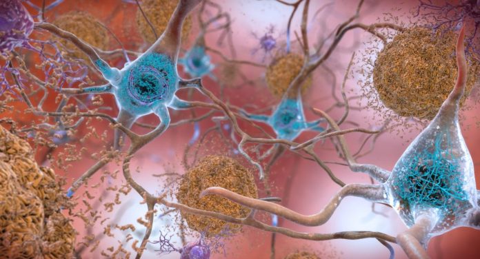Brain Image Ilustração de beta-amilóide e tau no cérebro. Instituto Nacional do Envelhecimento. (2017). “Placas Beta-Amilóides e Tau no Cérebro” (Imagem: Flickr)
