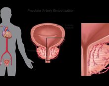 Prostate Artery Embolization (PAE) é um procedimento não-cirúrgico, guiado por imagem, desenvolvido para diminuir a próstata e aliviar os sintomas urinários causados pelo BPH (Foto: Divulgação)