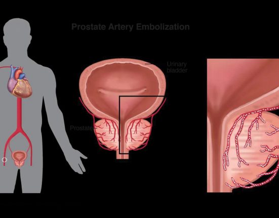 Prostate Artery Embolization (PAE) é um procedimento não-cirúrgico, guiado por imagem, desenvolvido para diminuir a próstata e aliviar os sintomas urinários causados pelo BPH (Foto: Divulgação)