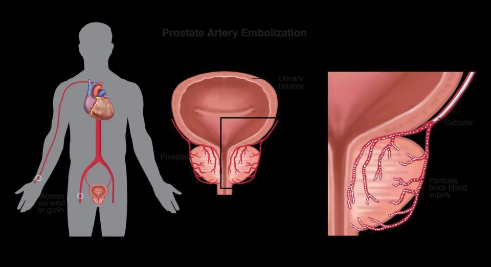 Prostate Artery Embolization (PAE) é um procedimento não-cirúrgico, guiado por imagem, desenvolvido para diminuir a próstata e aliviar os sintomas urinários causados pelo BPH (Foto: Divulgação)